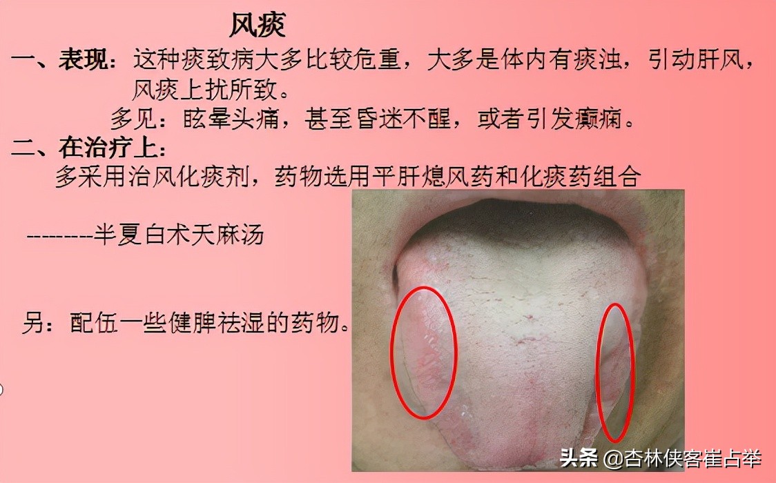 痰在肺则咳痰在胃则呕的意思,肺痰与胃痰