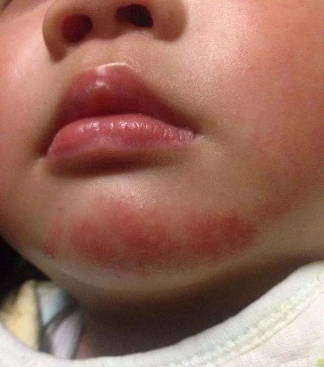 宝宝经常流口水是脾胃虚表现吗,宝宝老是流口水是因为肝火太旺吗