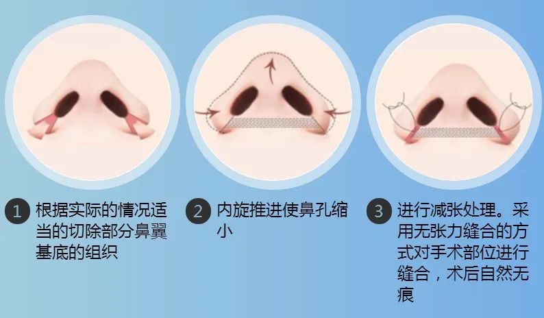 鼻头缩小鼻翼缩小前后对比图,鼻头缩小跟缩小鼻翼有区别吗