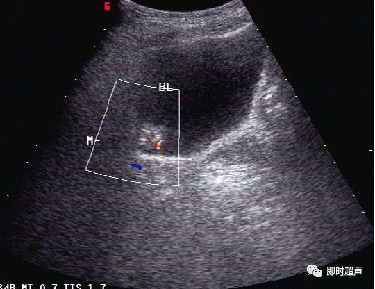 膀胱超声图解大全,膀胱超声解剖及常见病变超声表现