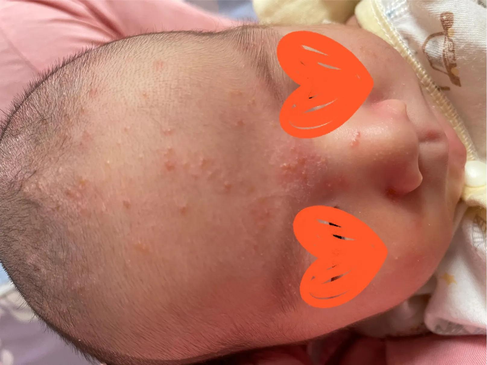 养宠物会不会造成孩子湿疹,孩子有干性湿疹能养宠物吗