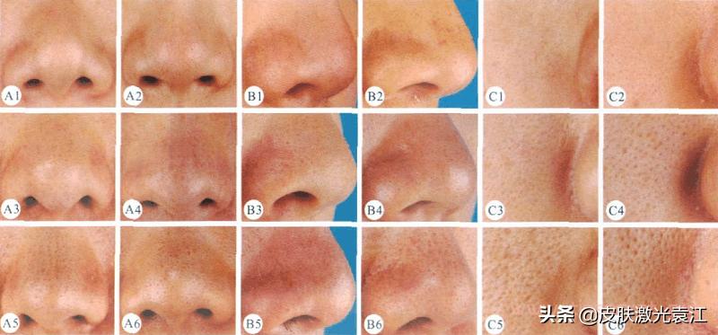 毛孔粗大5种类型改善方法,毛孔粗大程度分级