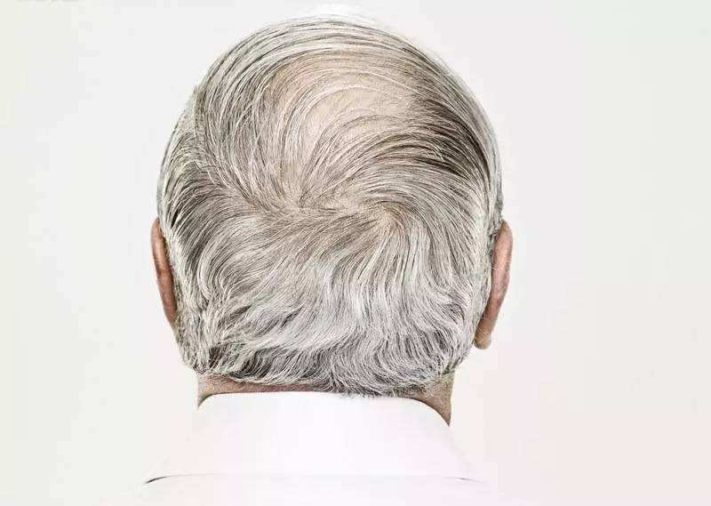 一夜白头怎么变黑,一夜白头怎么治疗