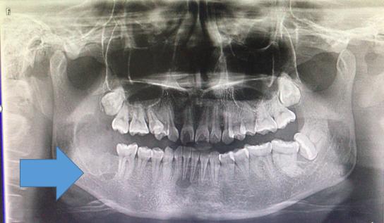 颌骨空洞是肿瘤吗,牙根部发现有个黑洞