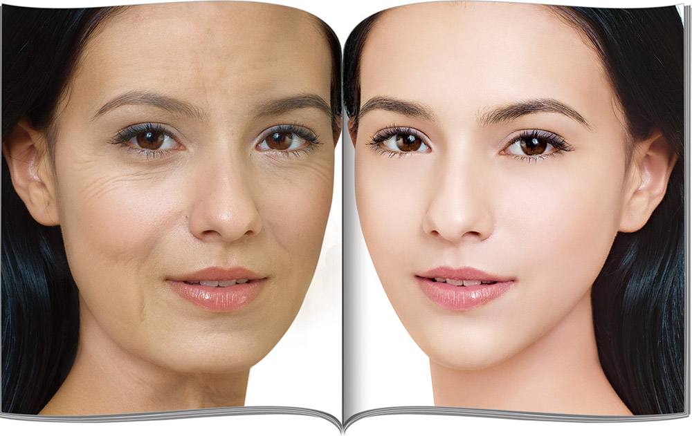 埋线提升,埋线提升需要几根线