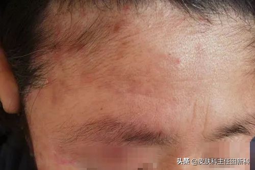 痘印变成斑点怎么治,痘印的种类以及成因你了解多少