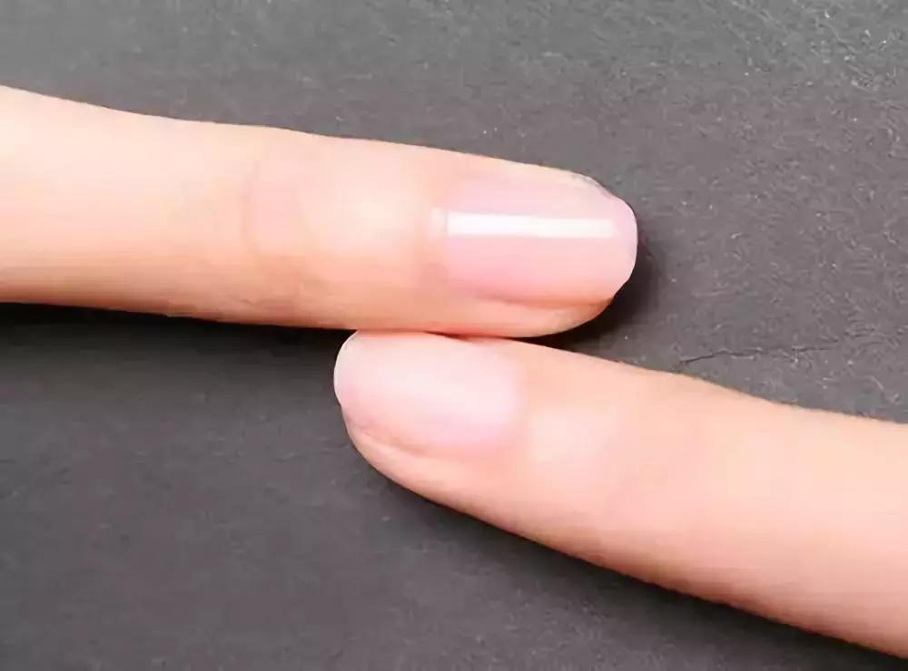 十岁孩子指甲上有竖纹是怎么回事,大拇指甲上有白色竖纹是怎么回事