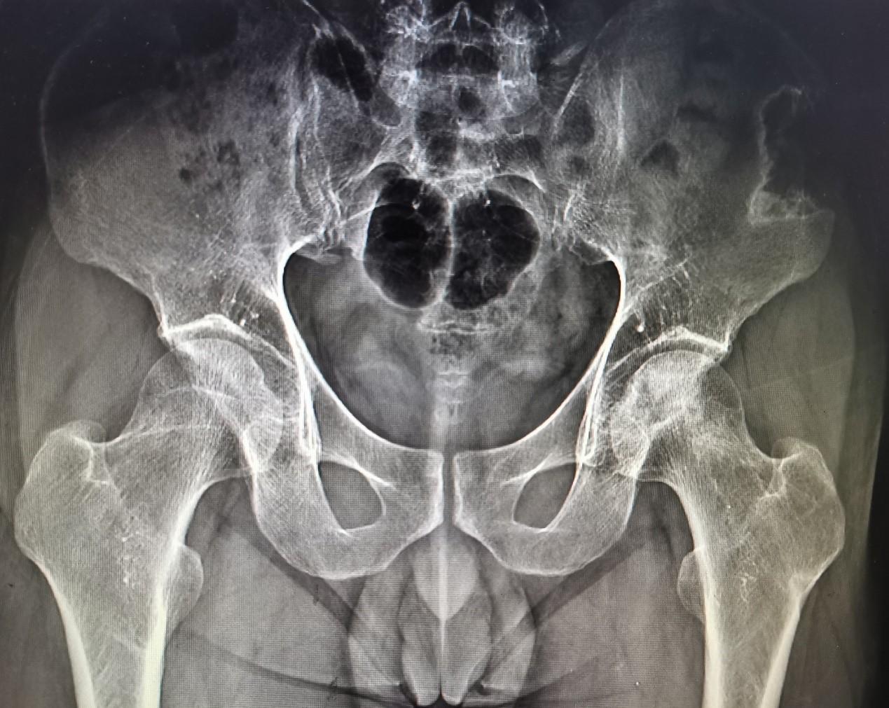 股骨颈骨折导致股骨头坏死的原因,股骨颈骨折如何避免股骨头坏死