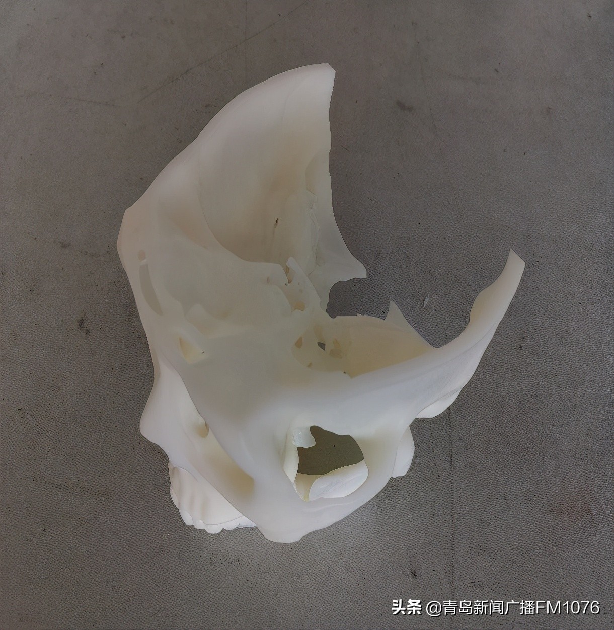 大妈脸不停抽搐，原是耳朵里藏了个大肿瘤，市立专家挑战高难度走位巧摘瘤