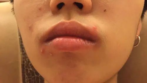 脸上老是长痘怎样内调,脸上老是长痘怎么办小妙招