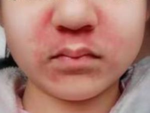 春季脸上过敏发痒图片,春季脸部过敏如何护肤