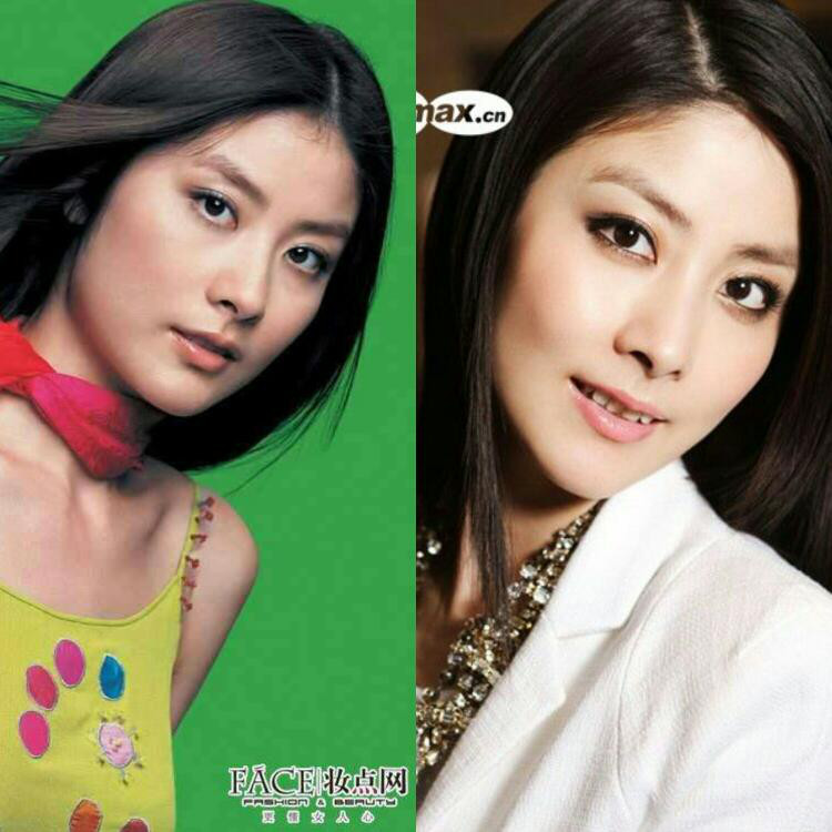哪个明星做了颧骨内推,颧骨内推明星前后对比