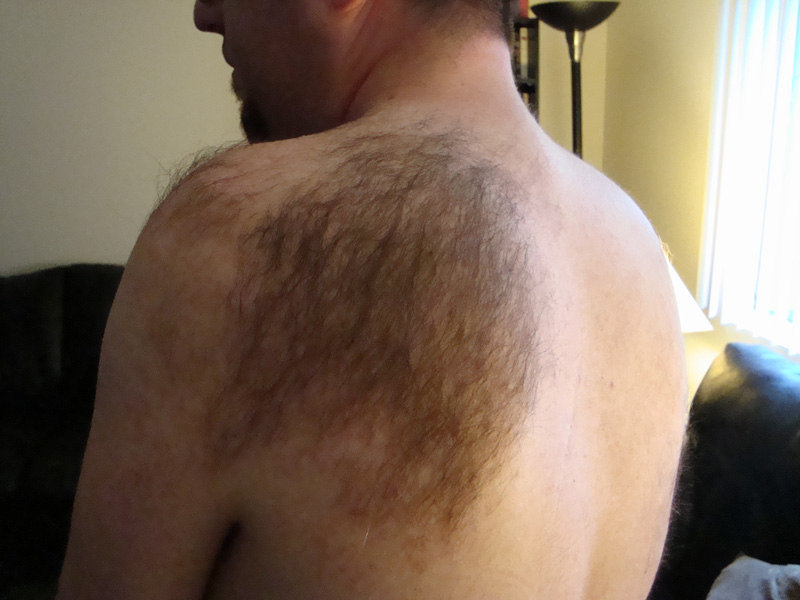 痣长在什么地方易癌变,痣几乎人人都有什么样的痣会恶变