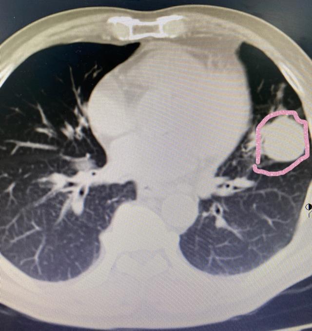 黑痣到底是什么样子,身上最可怕的黑痣