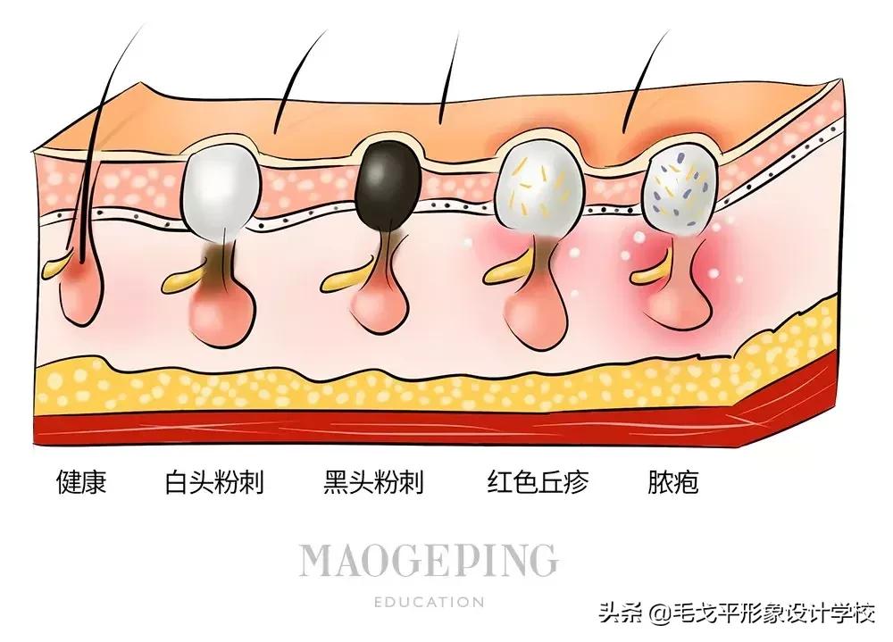 草莓鼻黑头毛孔粗大用什么药,去黑头草莓鼻小妙招