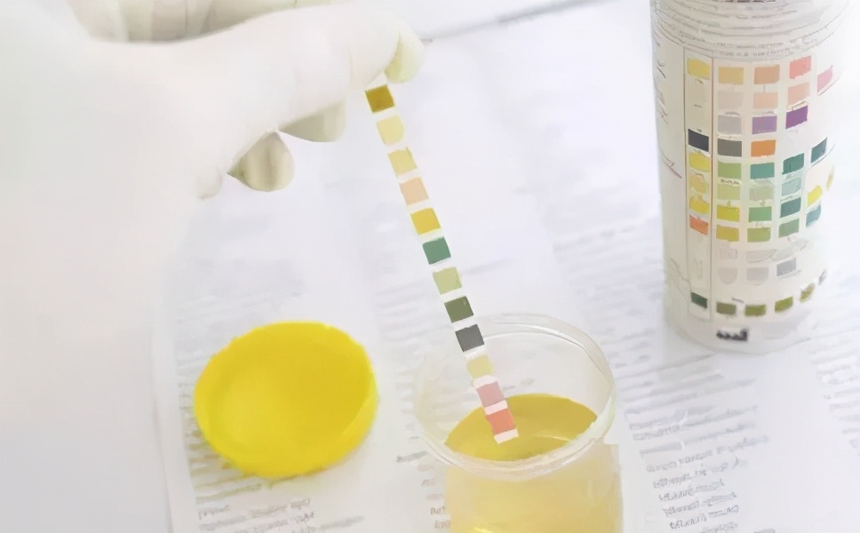 糖尿病肾病尿蛋白2一般多久转阴,肾病综合征复发了尿蛋白几天转阴