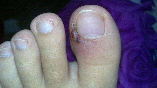 脚趾得了甲沟炎如何正确根治,脚趾甲长进肉里怎么彻底处理