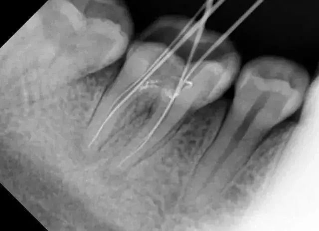 牙医警示看牙第一步为什么要拍片,牙医看牙片可以看出什么