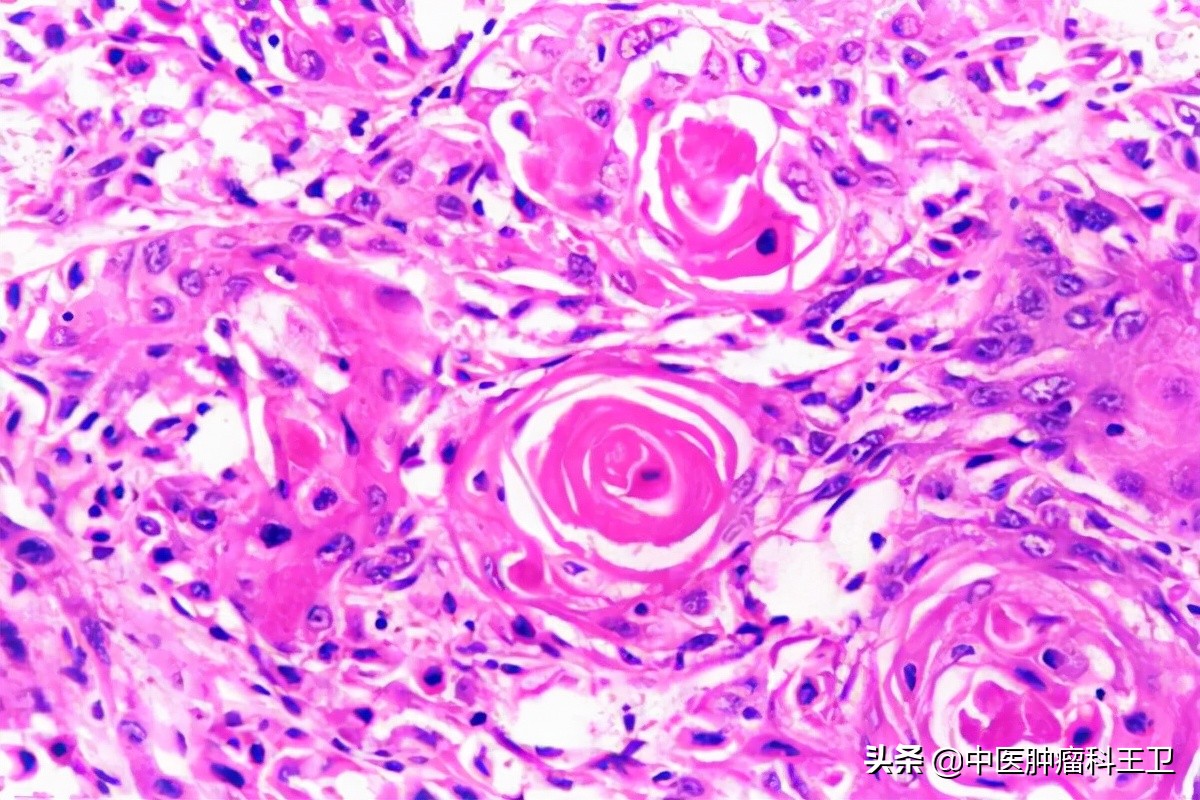 鳞状细胞癌太可怕了,夺走人生命的病