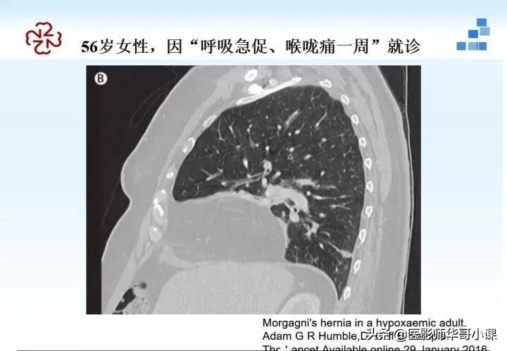 「精品课件」胸部膈肌的解剖及常见病变影像的表现