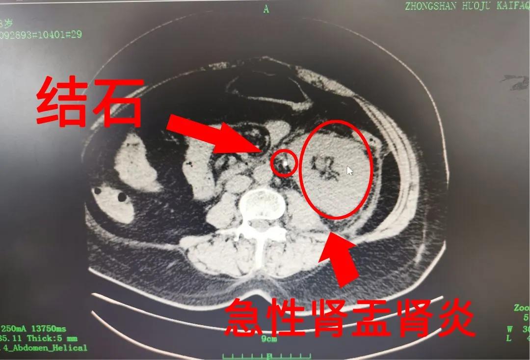 小结石3x3mm,3mm结石没感觉就出来了
