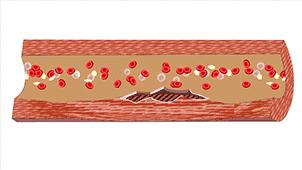 心脏缺血得注意保暖,心脏缺血该怎么安慰