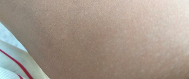 痘痘的防治方法有哪些,痘痘种类及去除办法