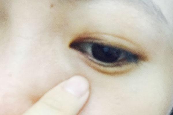 眼白里面有黑痣是怎么回事,眼白处有颗黑痣能不能去掉