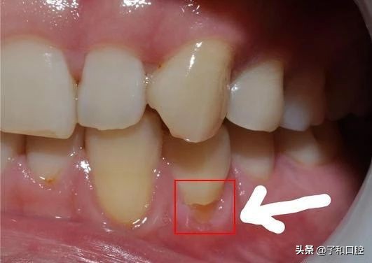 刷牙姿势不对牙龈有缝隙怎么补救,刷牙洗脸处好多苔藓