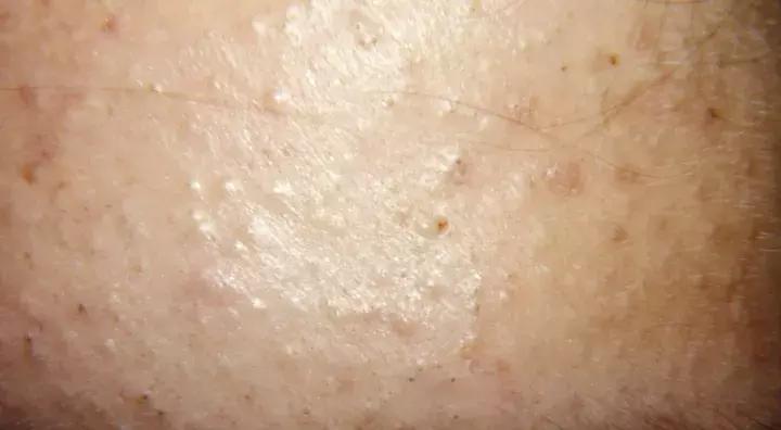 额头脸颊起小米粒痘痘怎么办,额头上的痘痘一直不消怎么办