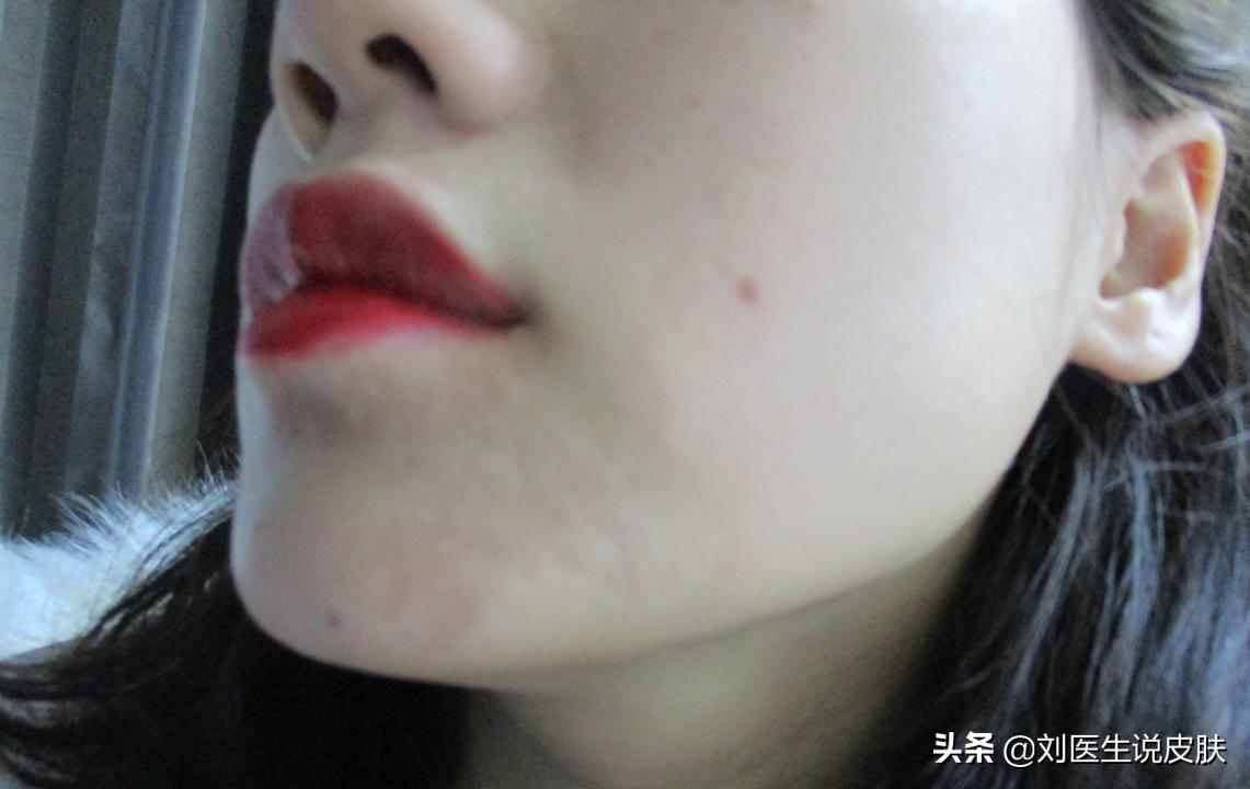 23岁女孩白癜风怎么治疗,29岁女人白癜风自愈