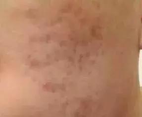 痘印祛痘药膏,痘印去除护肤品