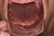 佛山种植牙齿全过程,南京牙齿种植案例分享