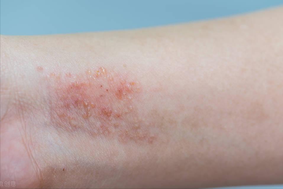 为什么湿疹反反复复这么顽固,为什么湿疹反反复复