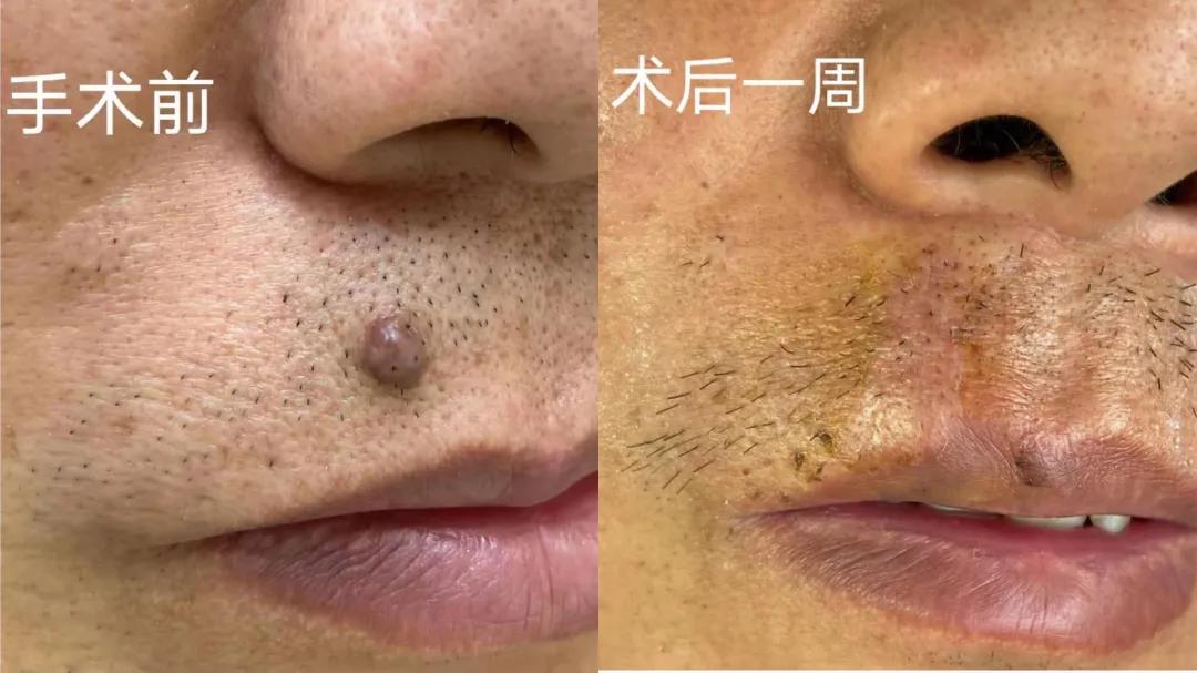 郝医生的治疗效果,全切祛痣一个月的疤痕效果