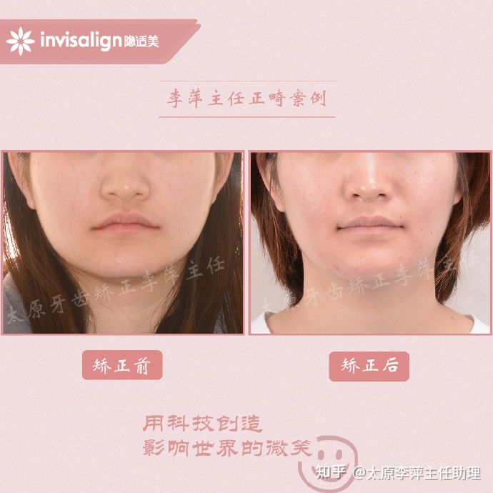 太原矫正牙齿需要做正颌吗,太原牙齿二次矫正