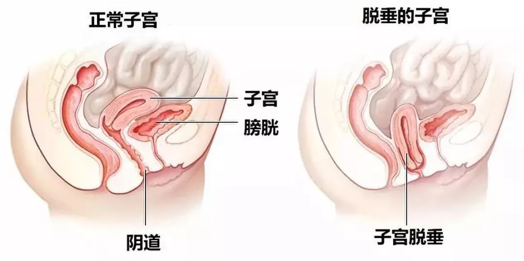 盆底肌松弛漏尿膨出最佳治疗方法,产后10年漏尿盆底肌康复