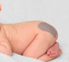 宝宝胎记的症状有哪些,宝宝出生有胎记是怎么来的