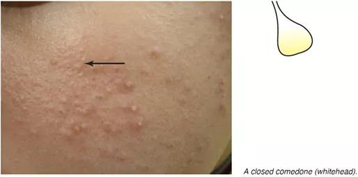 痘痘为什么越来越多如何正确祛痘,祛痘痘的效果是长痘痘还是消痘痘