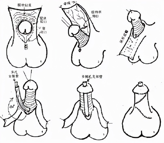 试管婴儿尿道下裂病因科普,尿道下裂伴随染色体异常如何处置