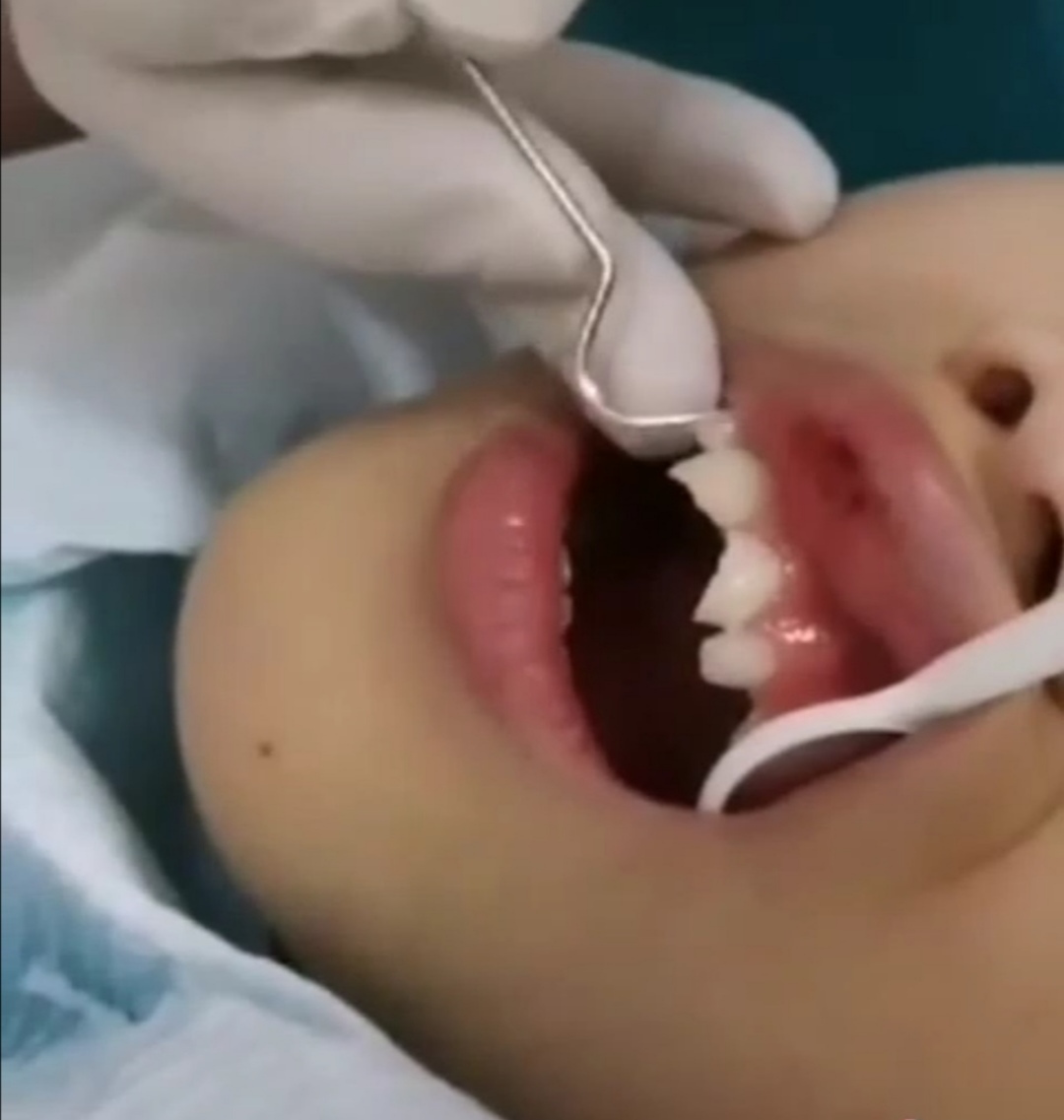 牙齿受外伤怎么办,牙齿外伤了该如何预防处理