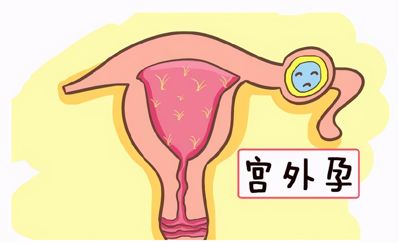 最离奇的宫外孕,要命的怀孕宫外孕