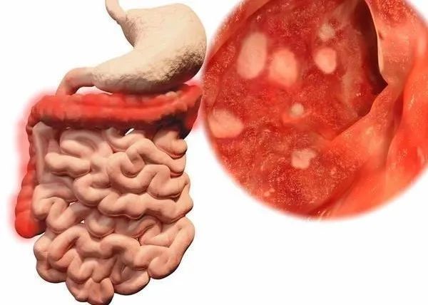 年轻人长期拉肚子是什么原因,年轻人频繁拉肚子吃什么药