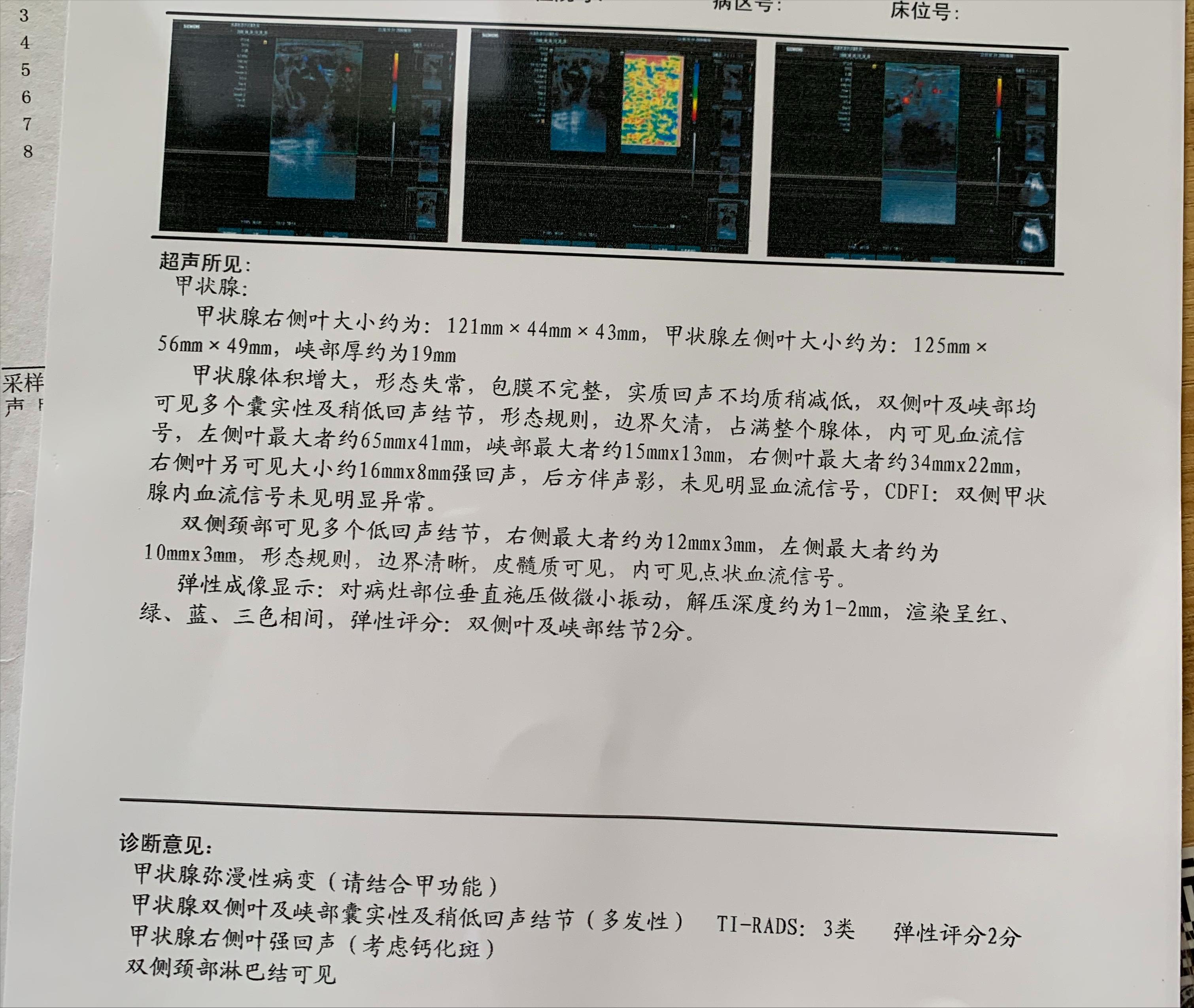 甲状腺结节07x06实性结节严重吗,甲状腺结节1.2厘米囊实性结节