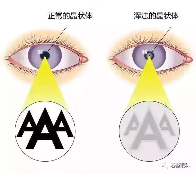 治疗白内障,治疗白内障的效果图