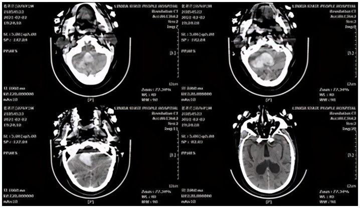 基层医院神经外科微创脑出血前景,高血压脑出血新突破