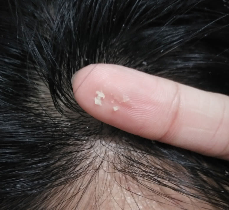 头油头痒还长小疙瘩用什么洗发水,头皮下长虫用什么药治疗