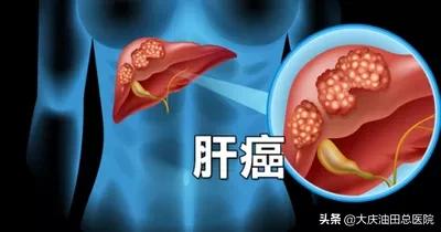 微创介入手术从哪年开始的,介入微创手术成功率和后遗症