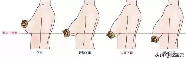 产前产后乳房变化,怀孕生子如何预防胸部变形