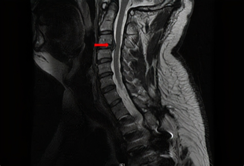 手麻什么病,手麻是什么病的前兆挂什么号